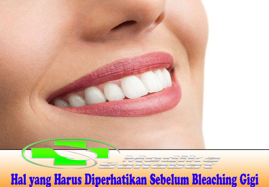 Hal yang Harus Diperhatikan Sebelum Bleaching Gigi