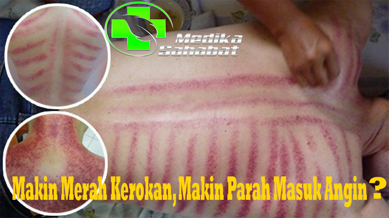 Makin Merah Kerokan, Makin Parah Masuk Angin?