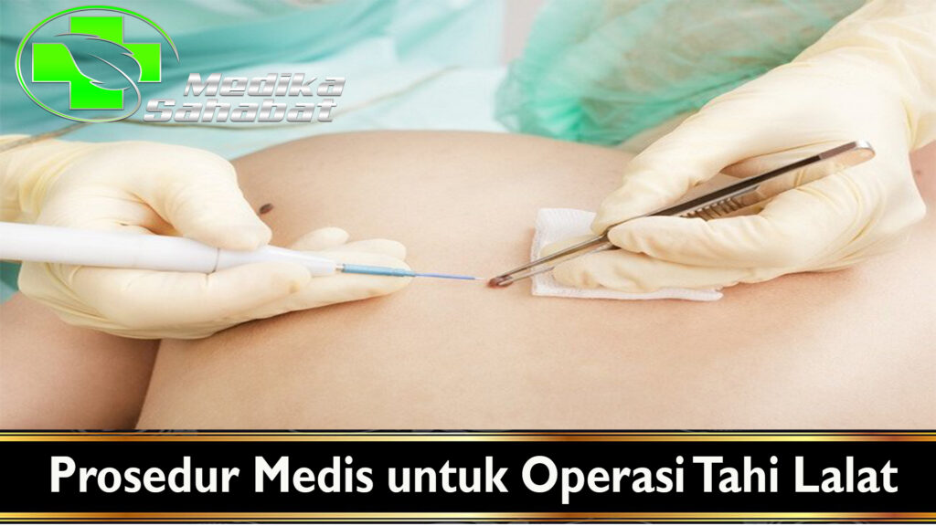 Prosedur Medis untuk Operasi Tahi Lalat