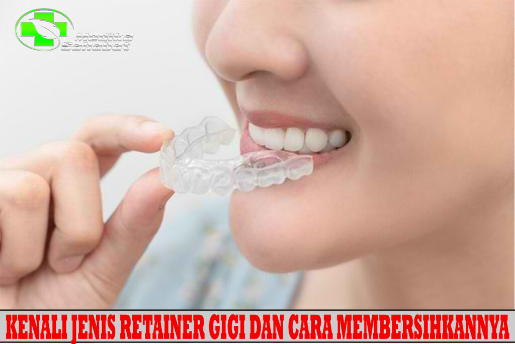 Kenali Jenis Retainer Gigi dan Cara Membersihkannya