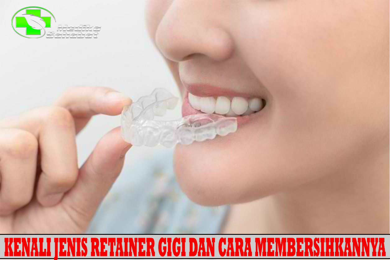 Kenali Jenis Retainer Gigi dan Cara Membersihkannya